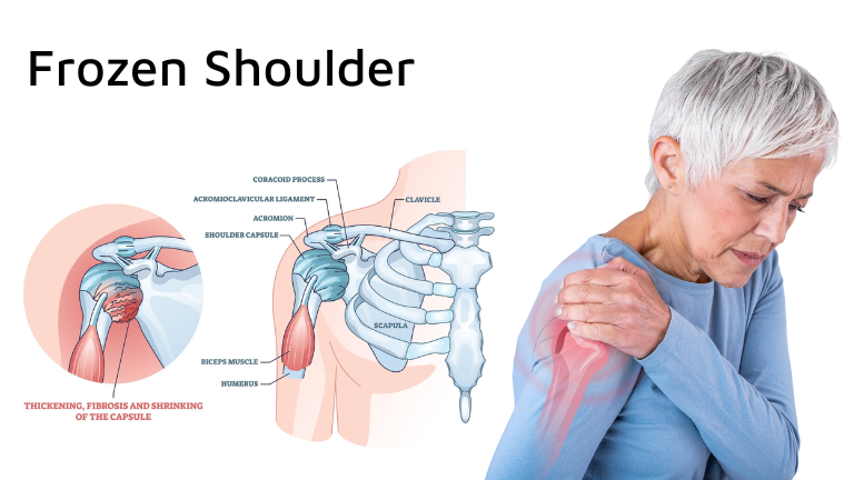 Frozen Shoulder Treatment in Jaipur